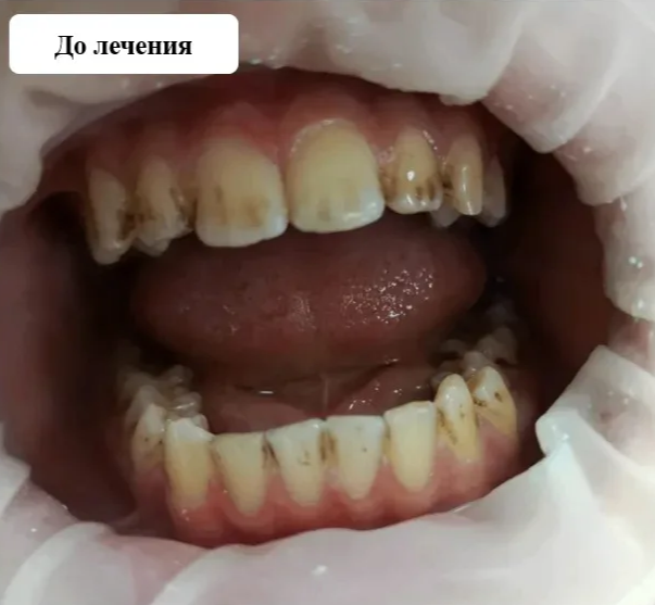 У воронежского школьника почернели зубы из-за колы и крепкого чая