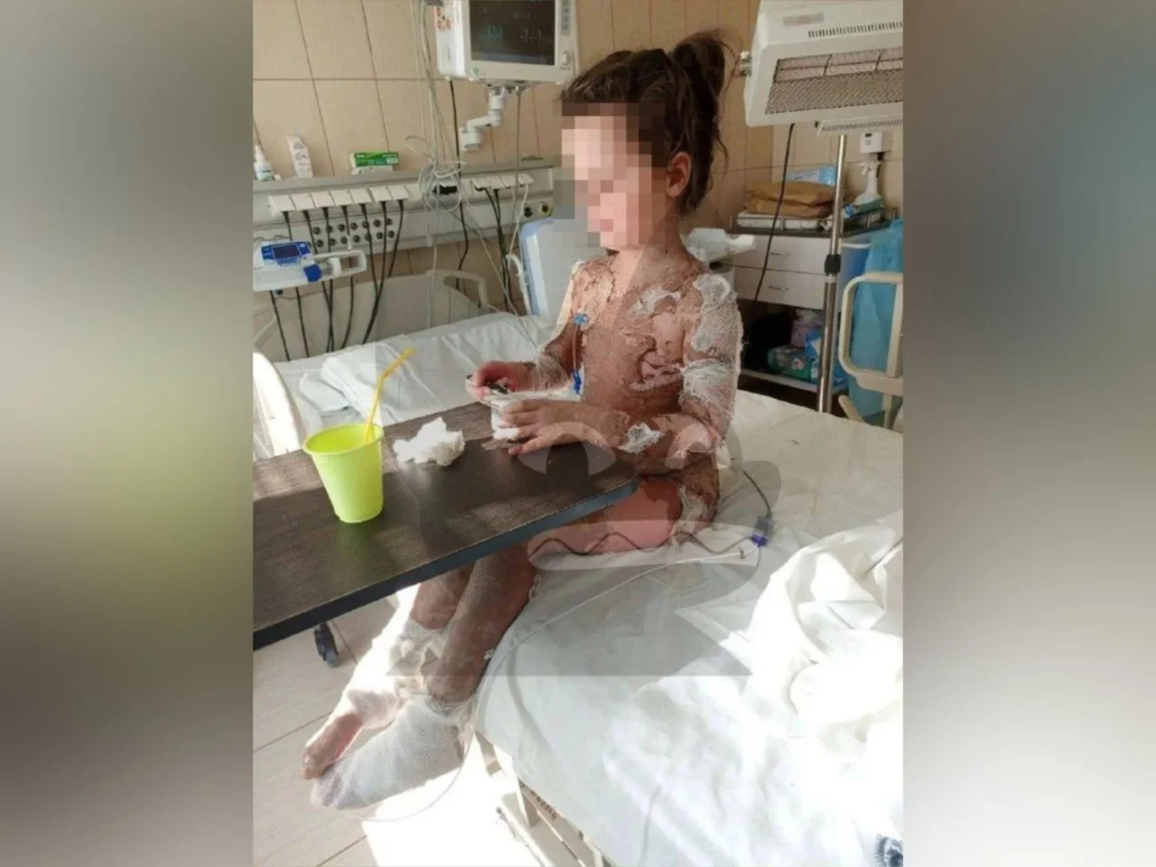 Лечение в частной клинике Воронежа довело девочку до отслоения кожи и реанимации